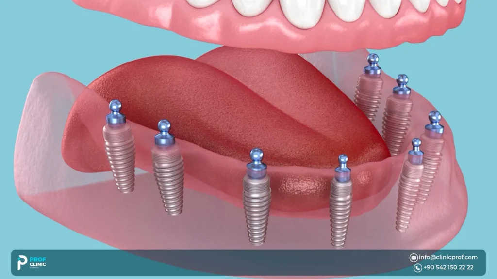 Why choose All-on-8 dental implants?