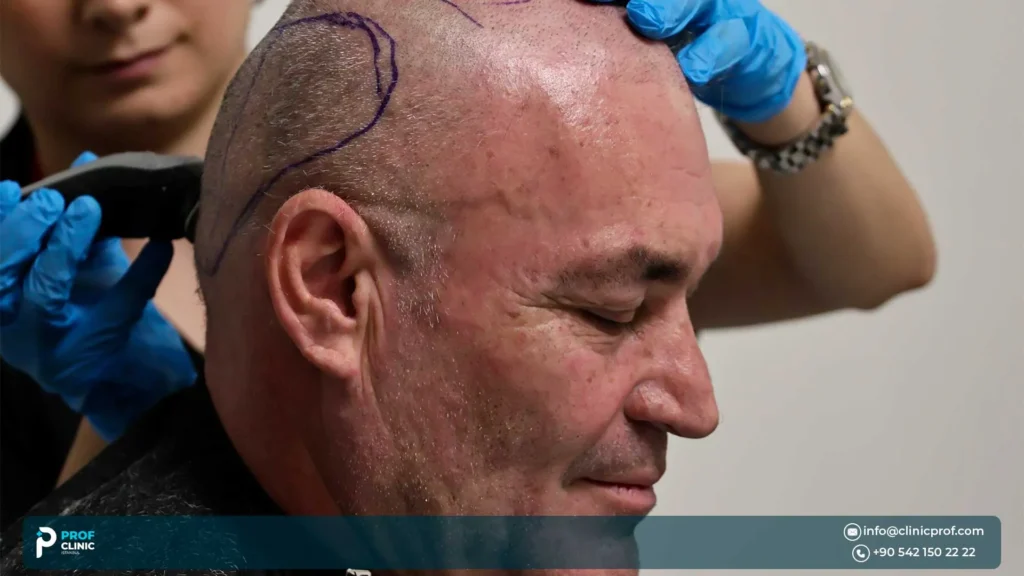 Key Technical Factors Driving a High Afro Hair Transplant Success Rate