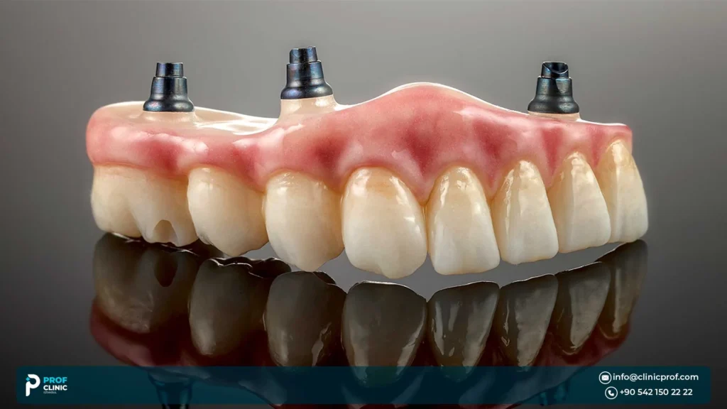 Fixed implant dentures