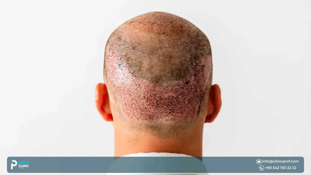 Afro Hair Transplant for Men: Complete Guide for Male Pattern Baldness