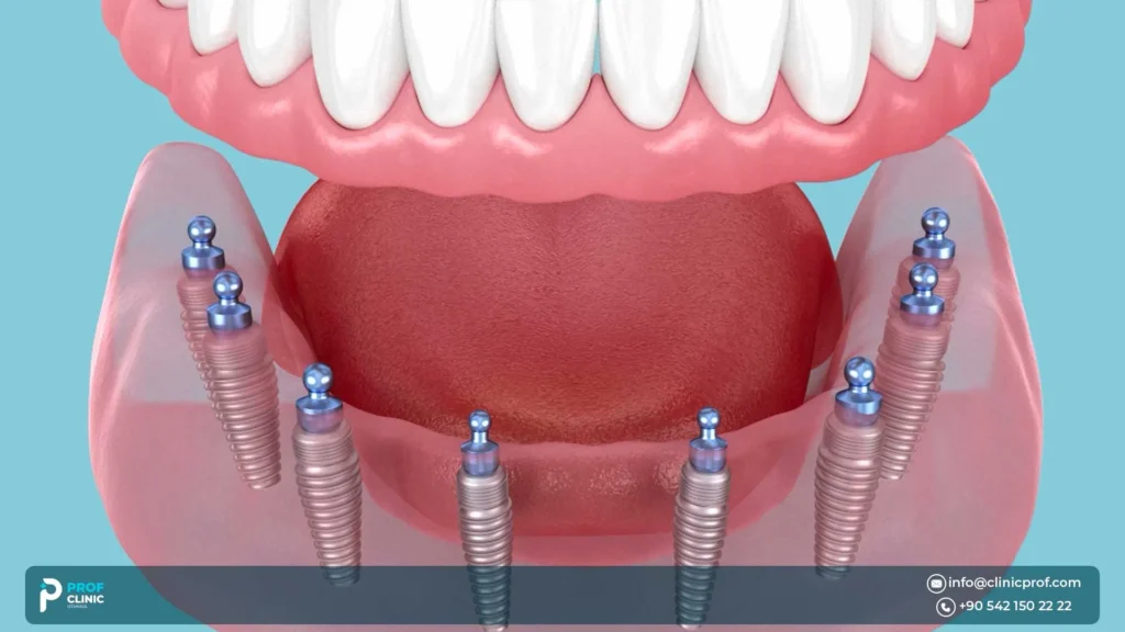 How does the All-on-8 procedure work?