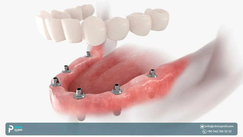 What are All-on-6 dental implants?