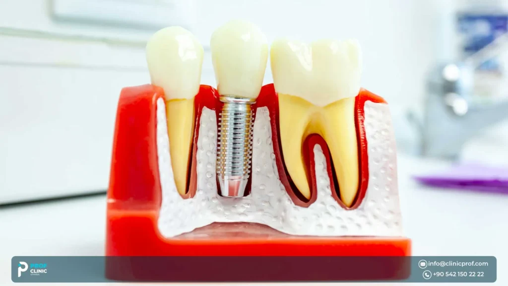 What is a two-stage implant?