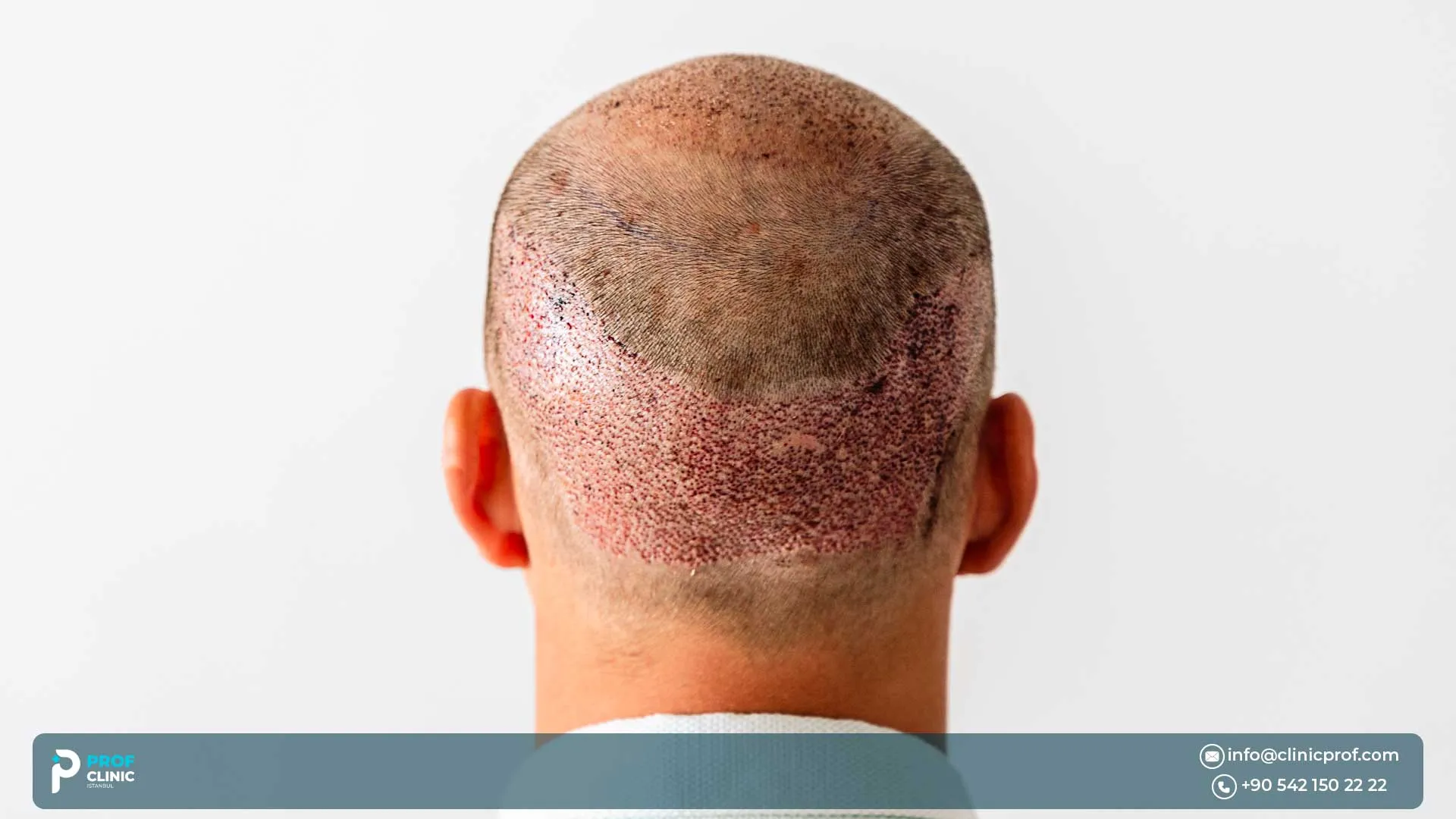 Afro Hair Transplant for Men: Complete Guide for Male Pattern Baldness