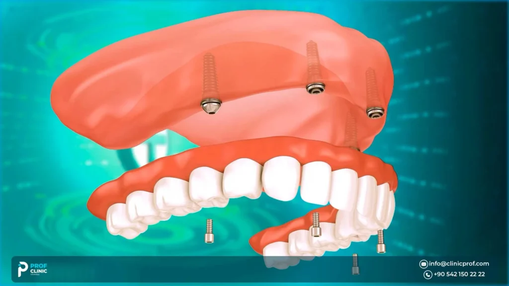 Bone Density & Primary Stability in the Upper Jaw
