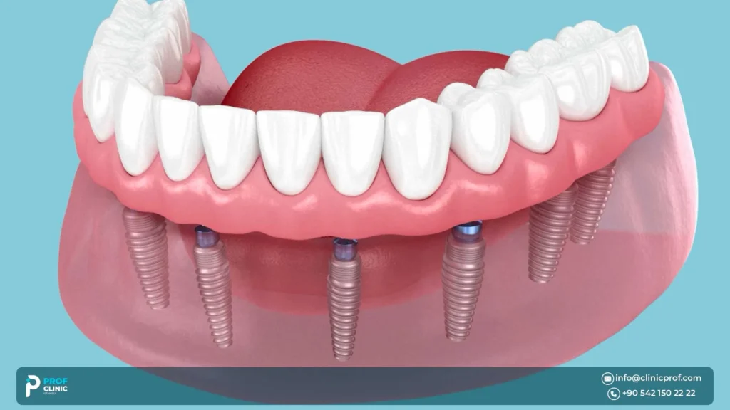 Cost factors and how to choose a clinic for All-on-8 in Turkey?