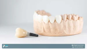 Zygomatic Implants Turkey: Solution for Severe Bone Loss