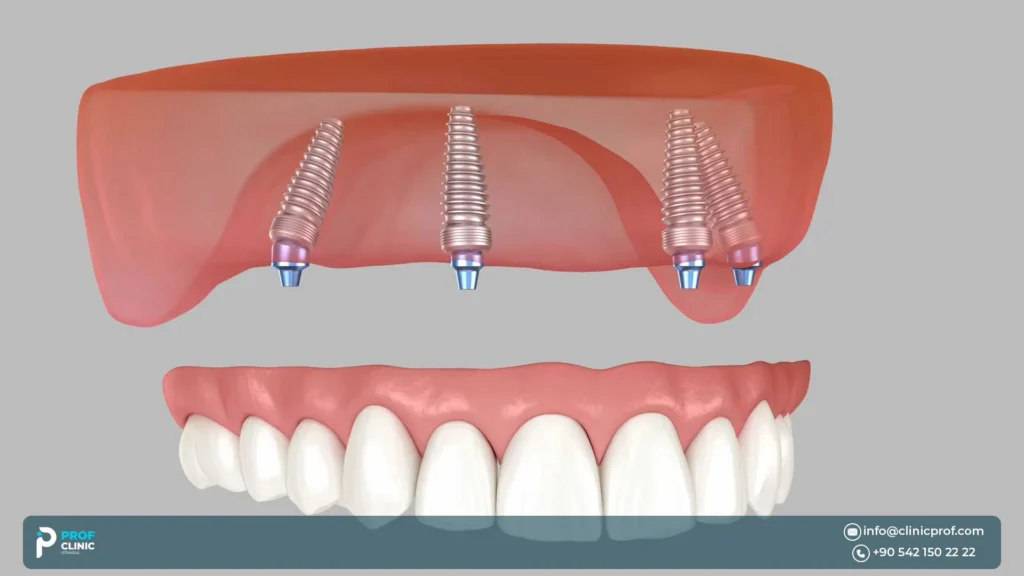Implant Angulation in the Upper Jaw