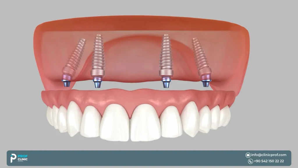 Recovery, Speech, Aesthetics & Same-Day Teeth in the Upper Jaw
