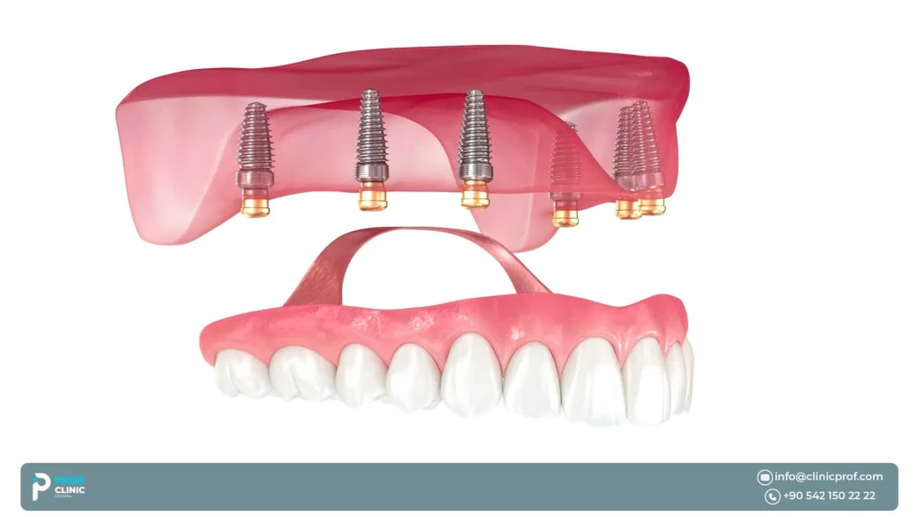 Why can six implants feel more secure?