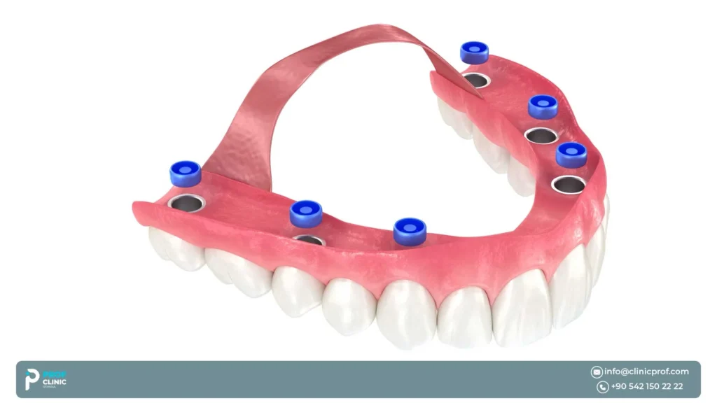 All on 6 dental implants: Step-by-Step Procedure