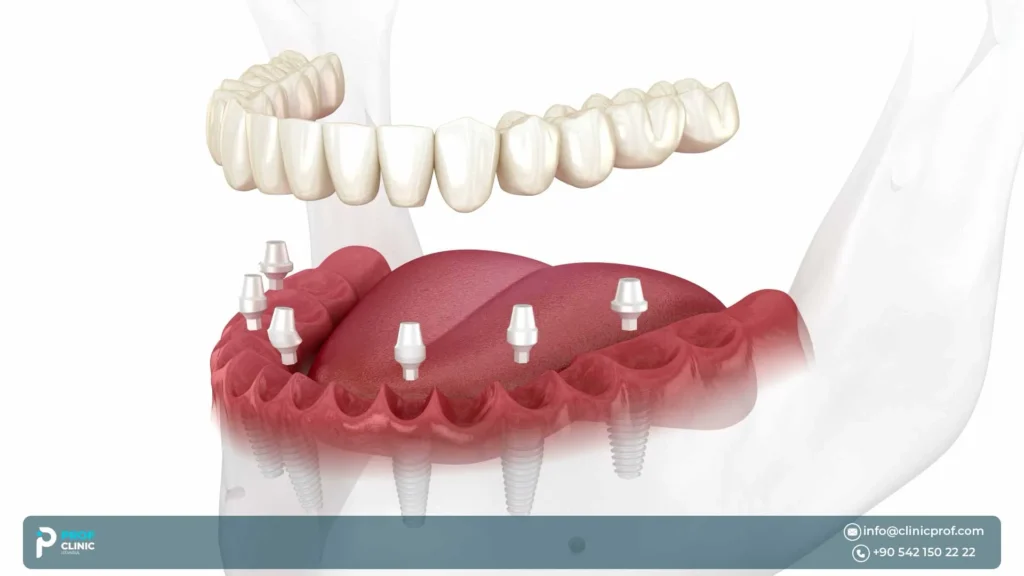 How long do All-on-6 dental implants last?