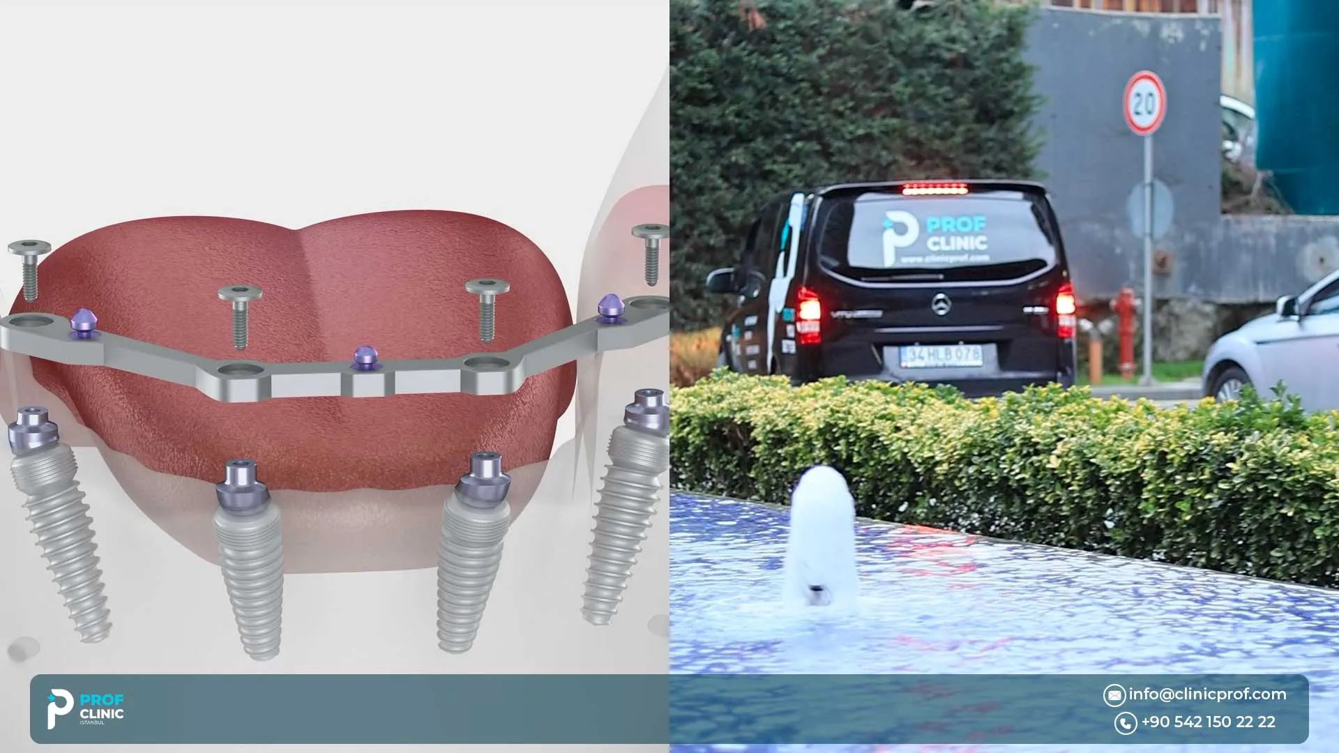 All-on-4 Dental Implants in Turkey: Complete Safety, Cost & Timeline