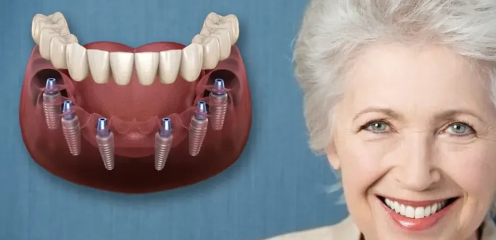 All-on-6 Dental Implants More Stability Explained