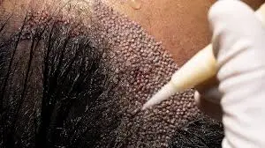Modern Hair Transplant Techniques for African American Women