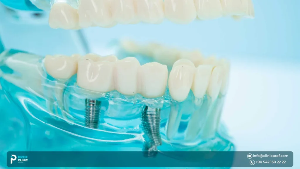 Dental Implants vs. Alternatives: Why implants win over bridges and traditional dentures.