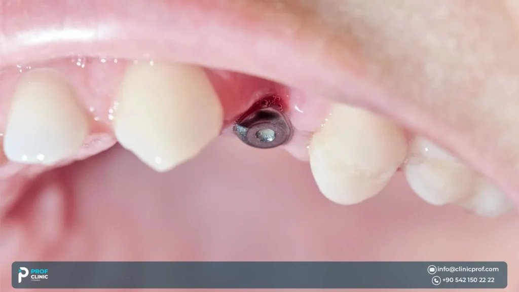 Flapless Dental Implant Surgery Minimally Invasive