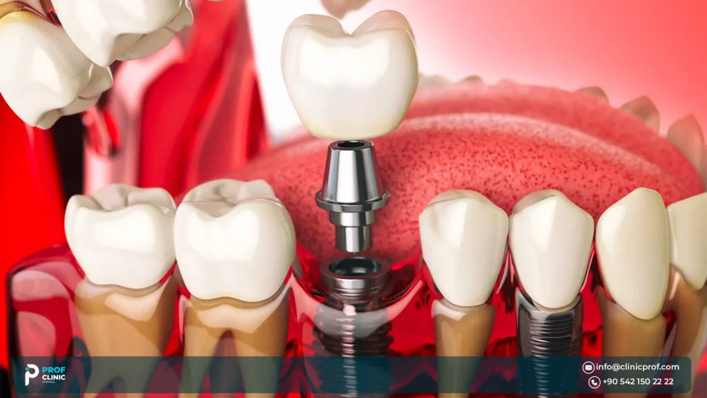 Immediate Load Dental Implants: Pros, Cons & Candidacy