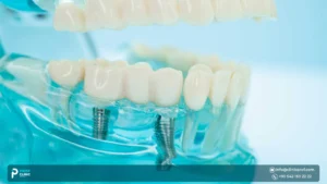 Implant-Supported Dentures vs Traditional Dentures Which Is Better for Stability and Comfort