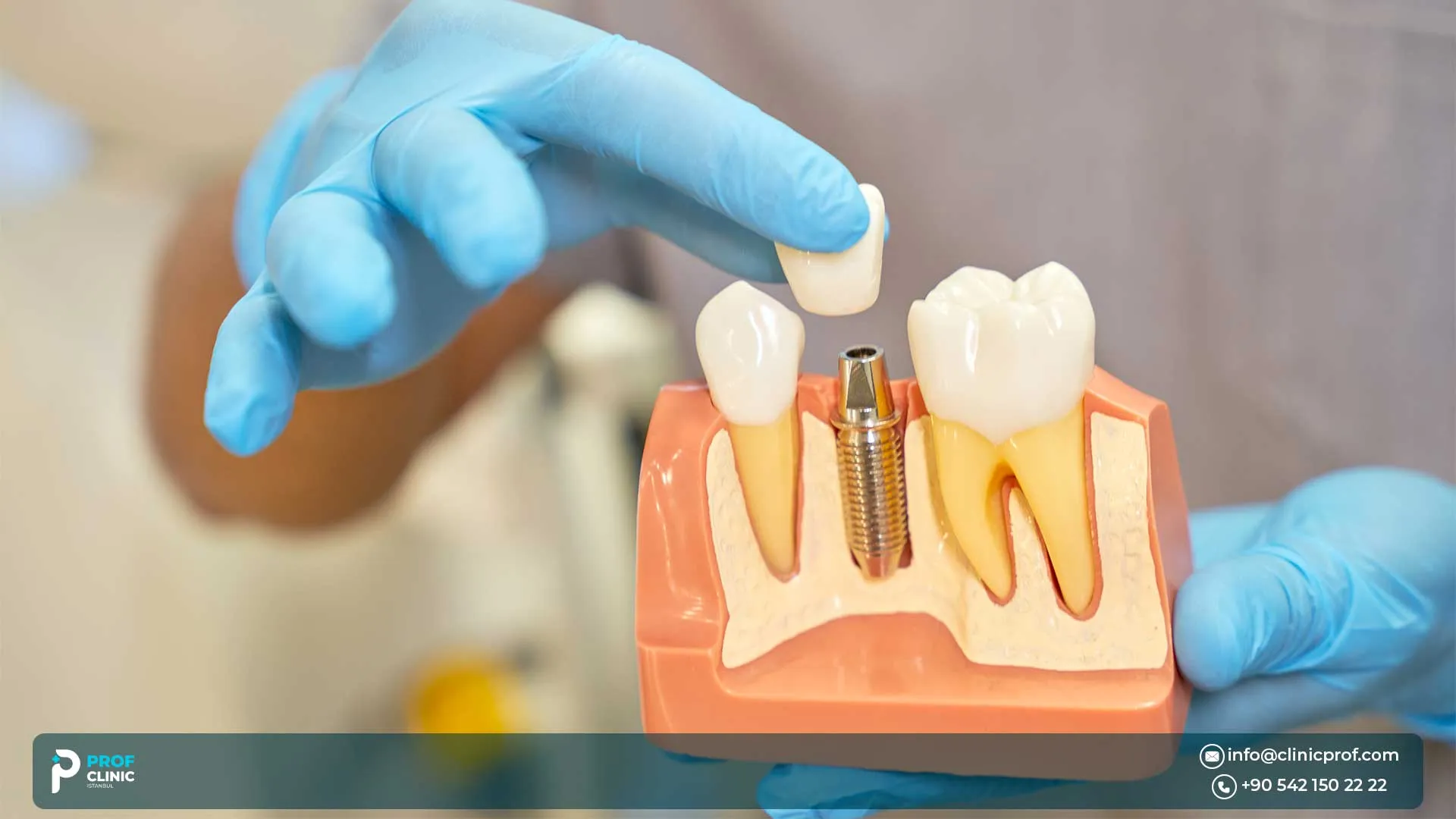 One-Stage vs Two-Stage Dental Implants