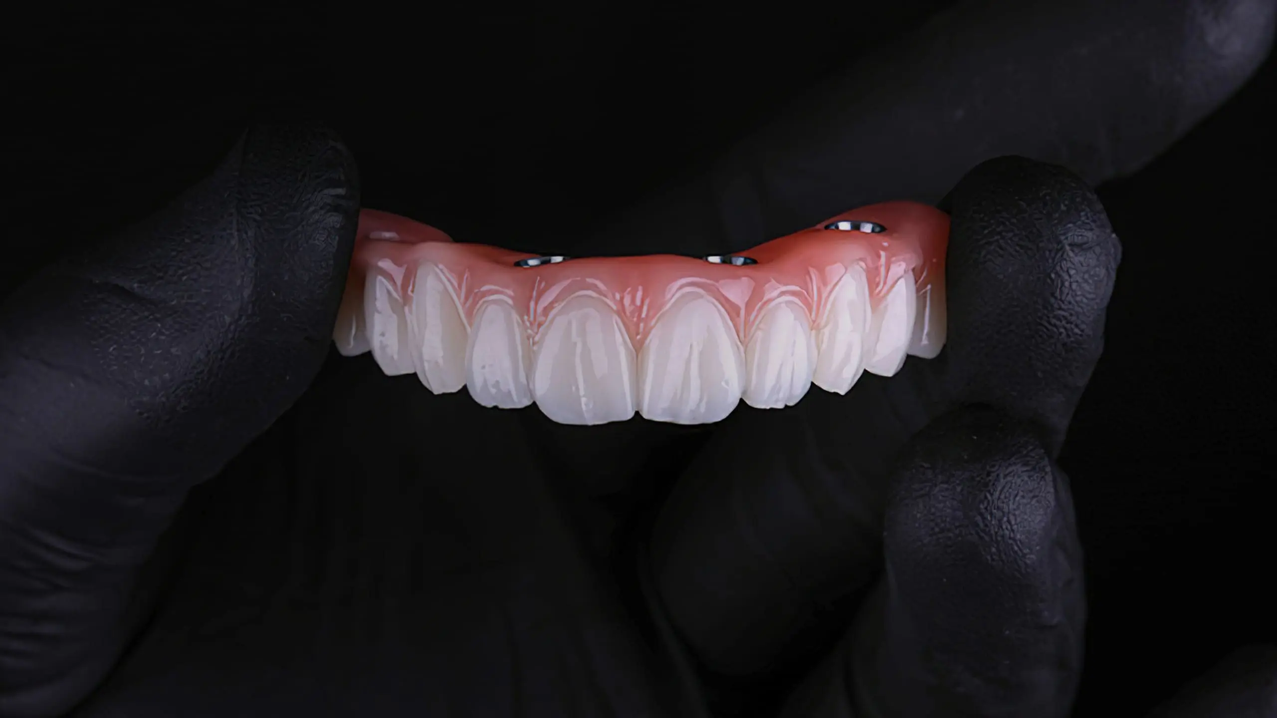 Same-Day All-on-4: Teeth in One Day Possible?