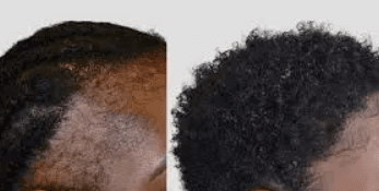 Benefits of Afro Women’s Hair Transplant in Türkiye
