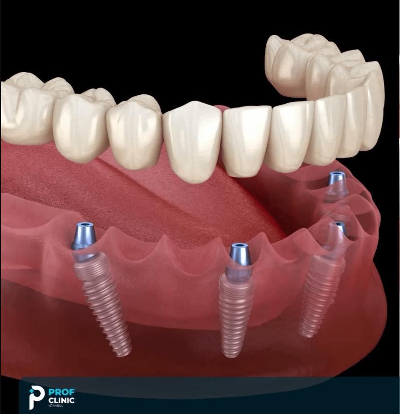 How the Lower Jaw All-on-4 Procedure Works in Istanbul?