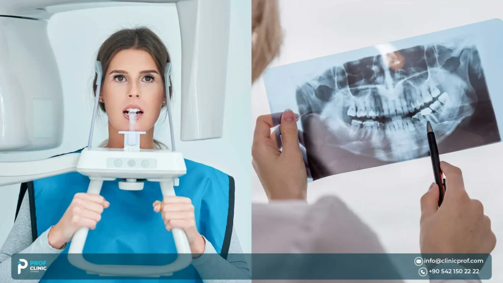 Safety, Risks, and Sinus Questions about All on 4 Zygomatic Implants