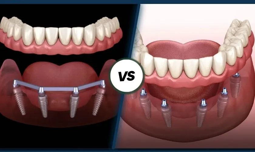 All on 4 vs all on 6 explained: stability, bone needs, one-day teeth, maintenance, and cost drivers. Request a full-arch implant plan in Istanbul.