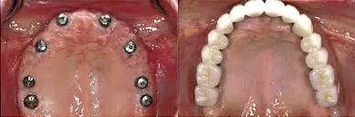 All-on-8 Implants: Maximum Support Option