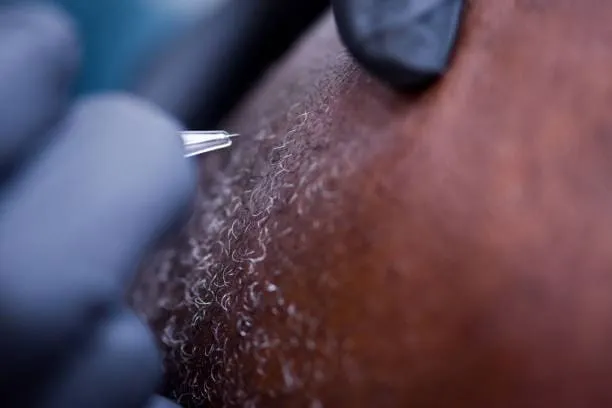 تحديات زراعة الشعر للرجال السود 