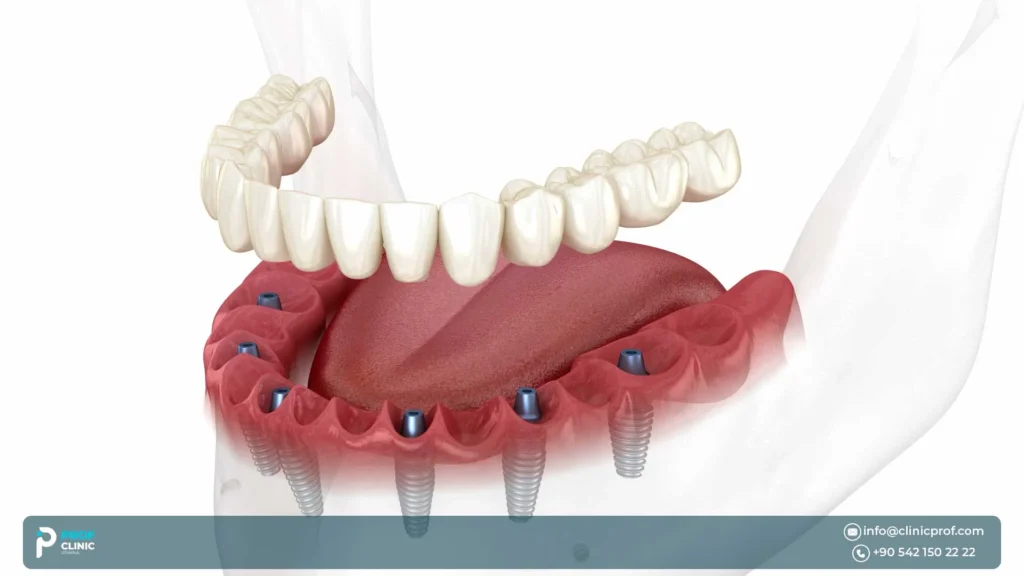 إجراءات زراعة الكل على 6 في اسطنبول: خطوة بخطوة