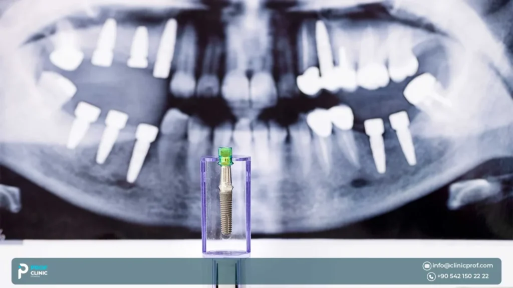 التخطيط ثلاثي الأبعاد والوضع الدقيق للغرسة
