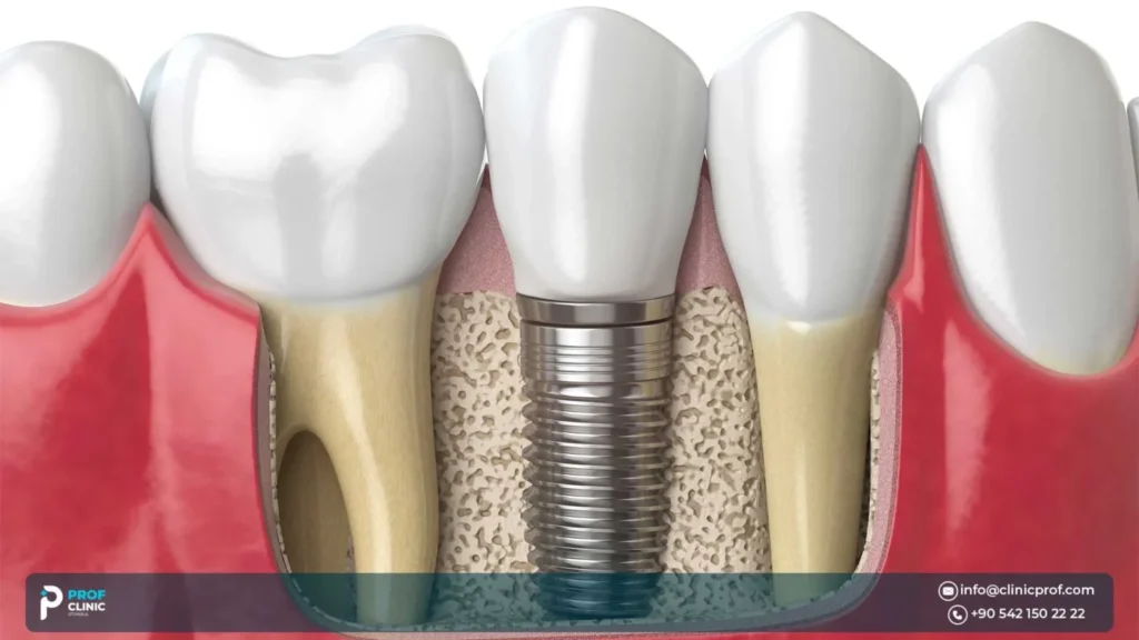 ما هي مميزات غرسات القطعة الواحدة (One-piece implants)؟