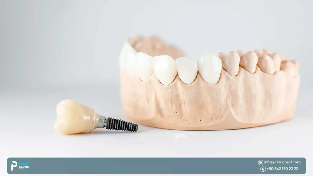 ماذا يحدث إذا لم تستبدل الأسنان المفقودة؟