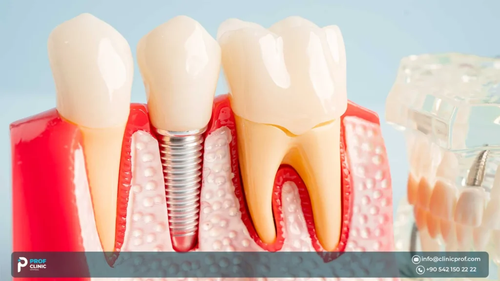 هل تدوم الزرعات القصيرة مثل الزرعات التقليدية؟