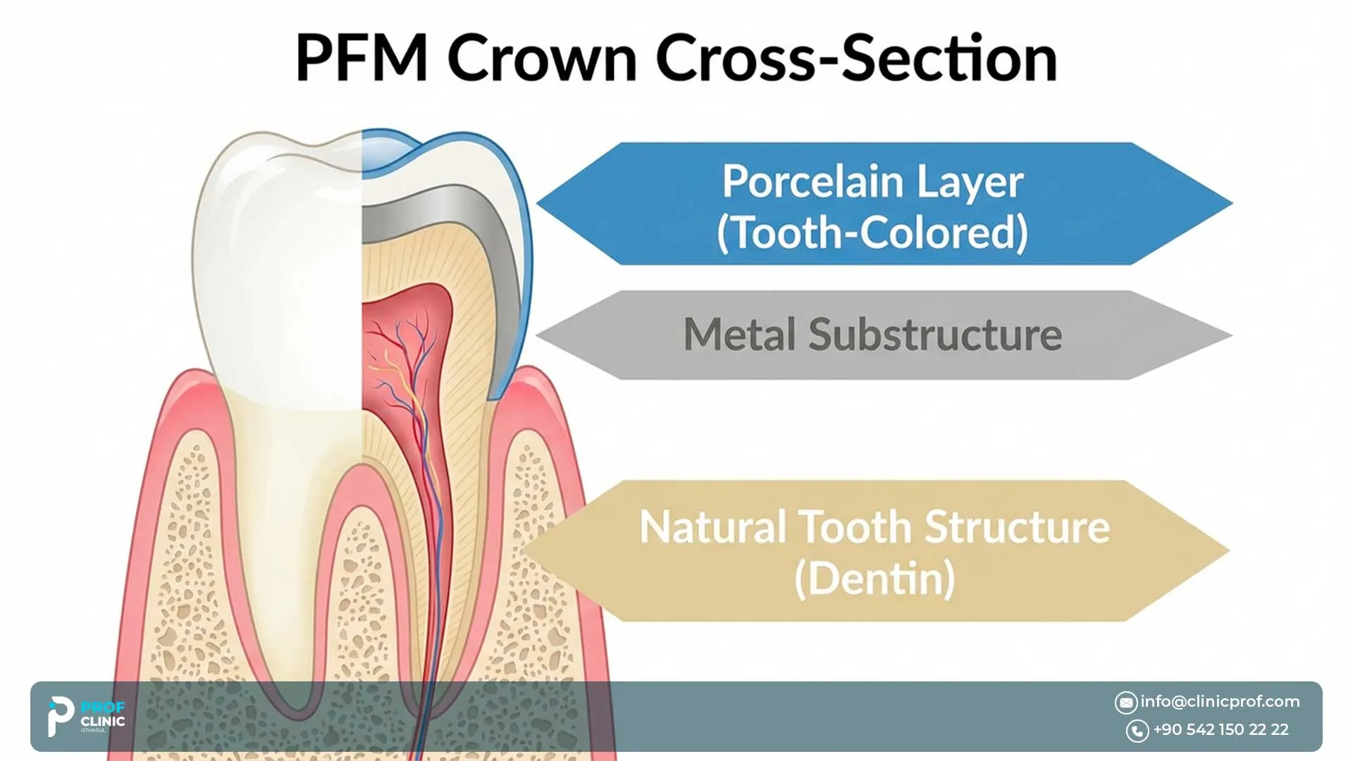 PFM Crowns for Implants in Turkey: Pros and Cons