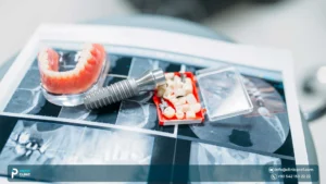 Are dental implants in Turkey as safe as those in other countries?