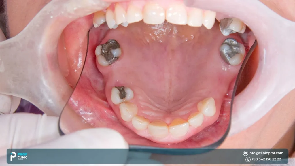 What can dental implant failure mean