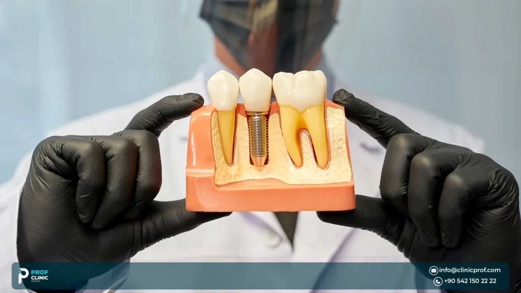 How does Prof Clinic Istanbul evaluate single implant vs bridge for one missing tooth