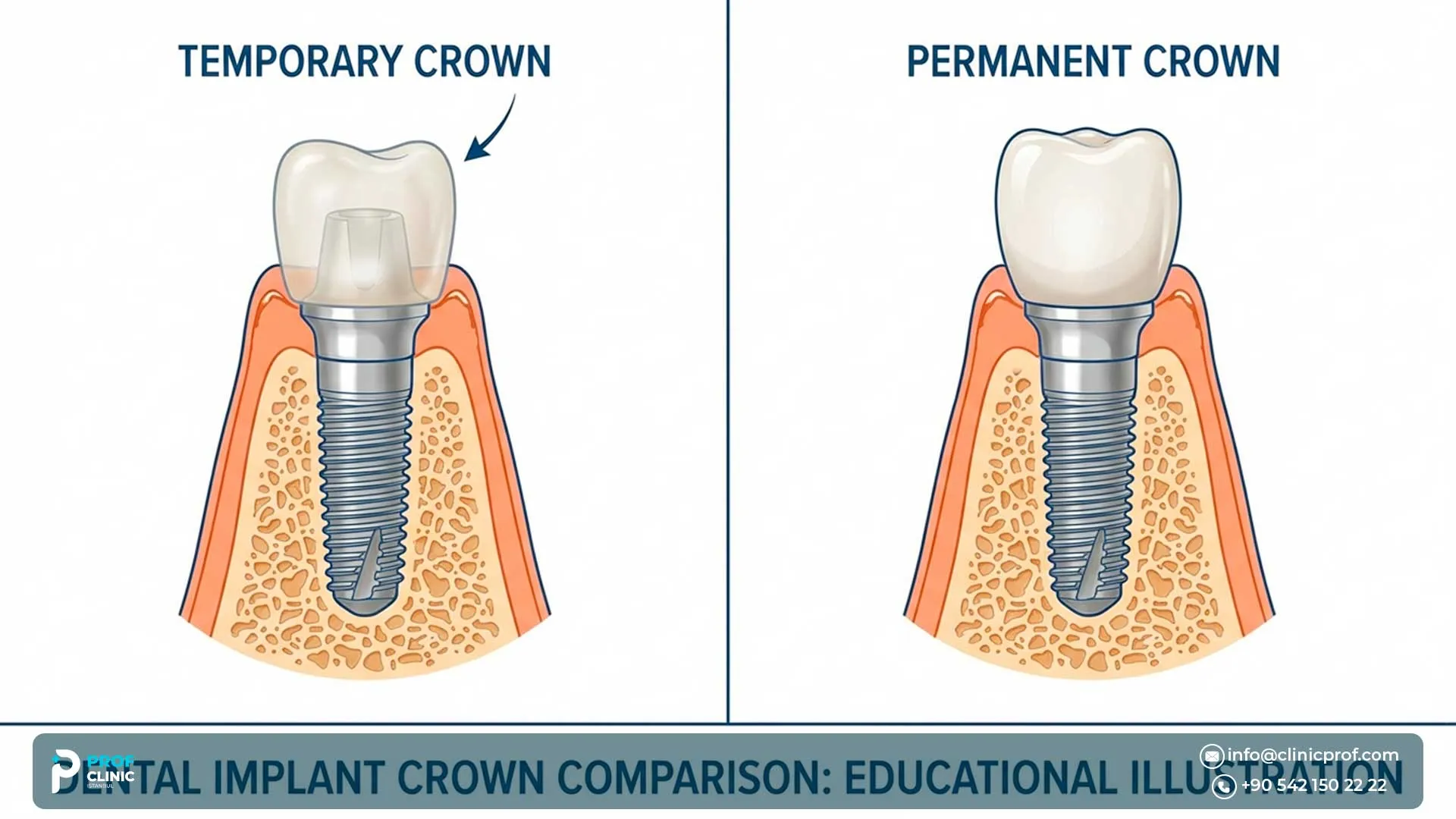 Temporary vs Permanent Implant Crown in Turkey