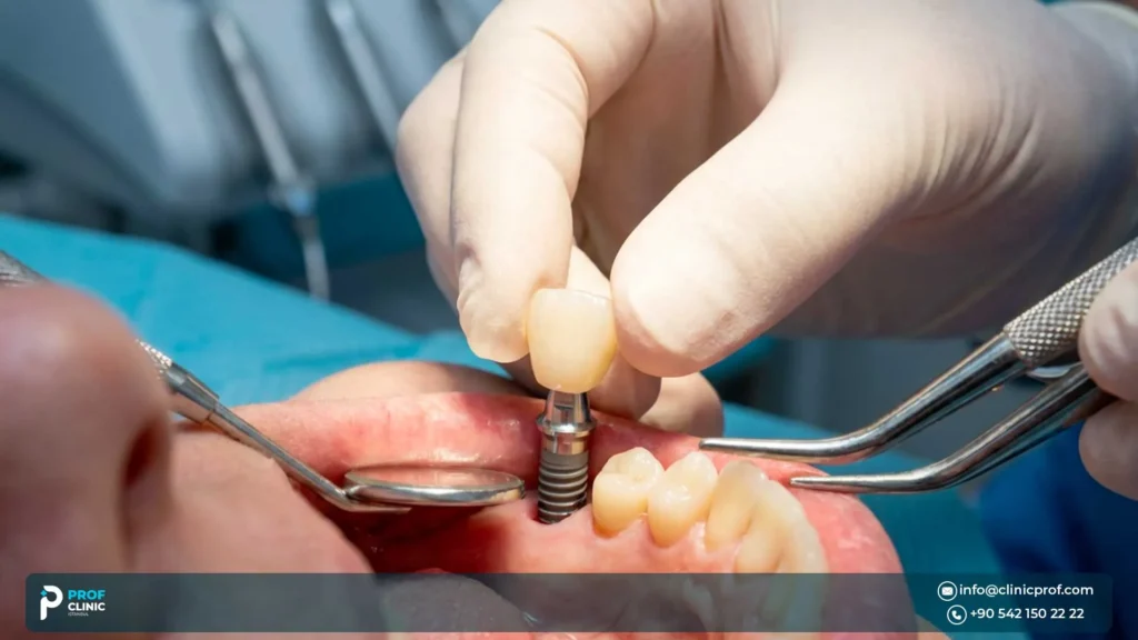Dental implant procedure at Prof Clinic in Istanbul, Turkey