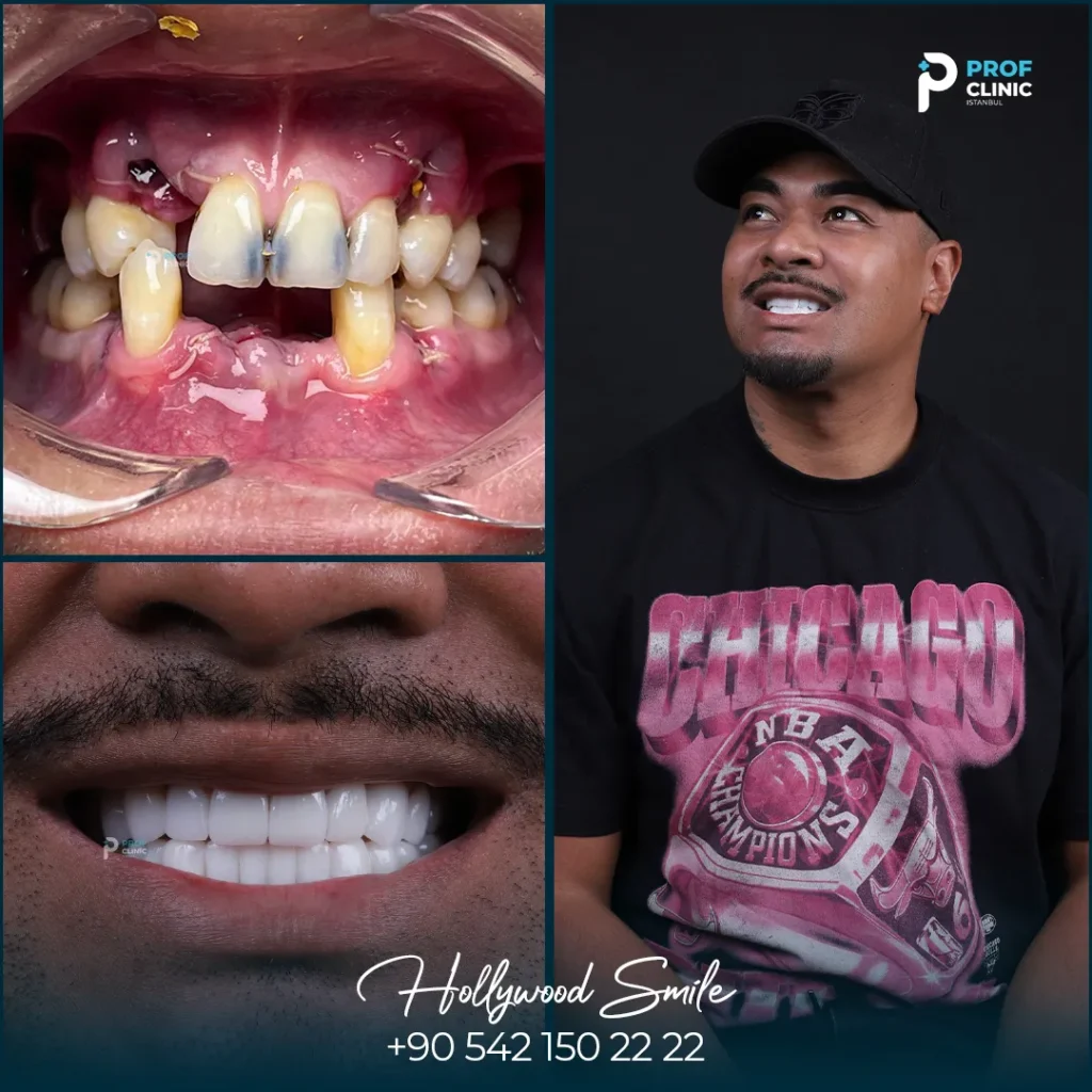 What does all on 4 success rate mean?