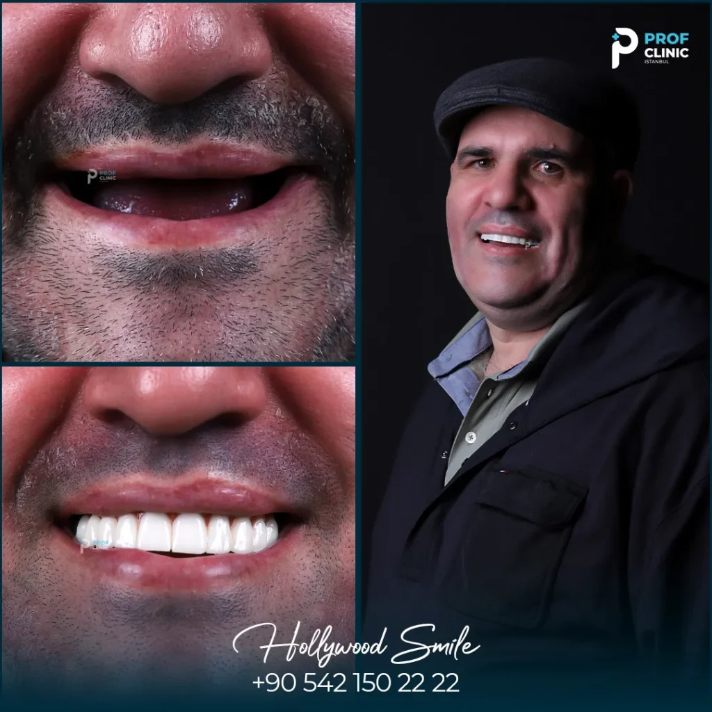 All on 4 recovery time: Practical timeline from surgery day to month 6+