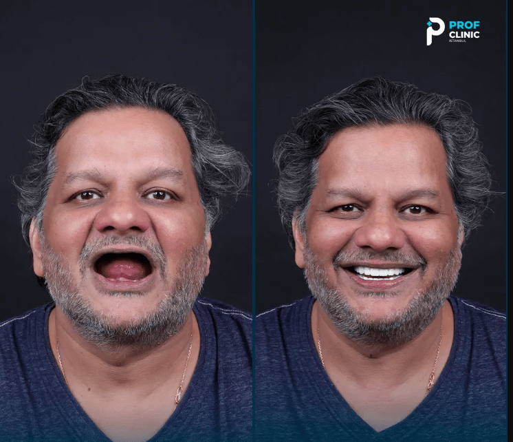 Who is a good candidate for an implant hybrid denture