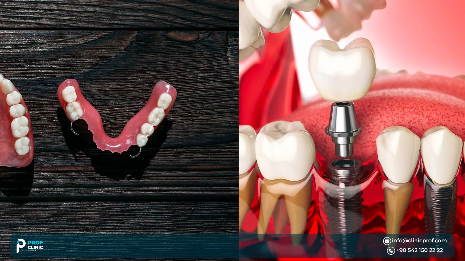 Single Implant vs Bridge in Istanbul: Replacing One Tooth