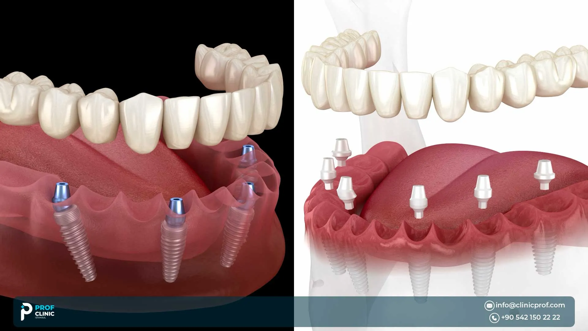 Hybrid Dentures on Implants in Turkey: Best of Both Worlds