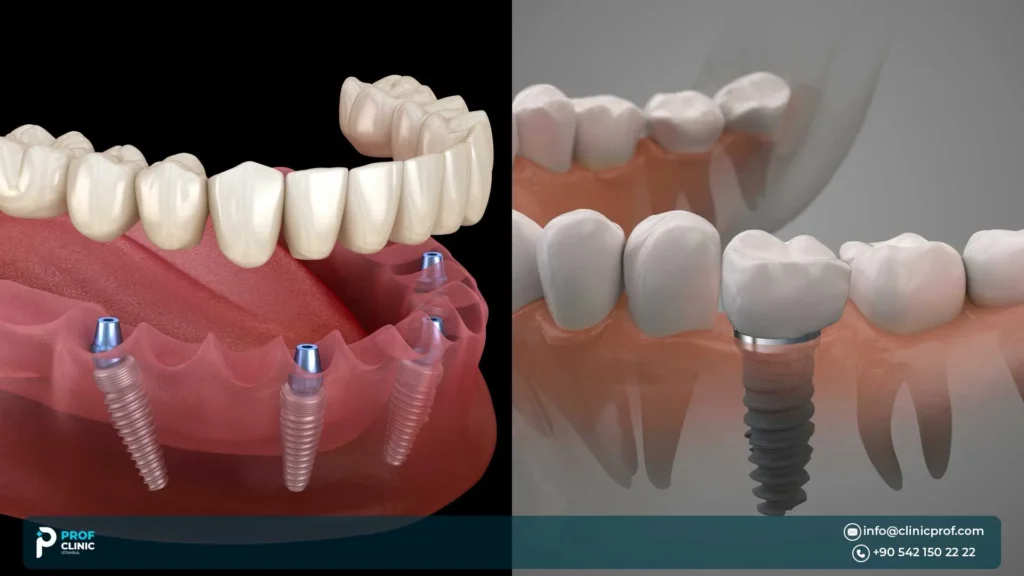 Temporary vs permanent teeth after All-on-4 surgery