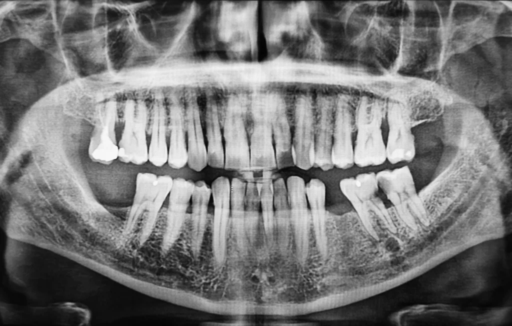 3D Dental Implant Planning in Turkey: What Changes Before Implant Surgery?