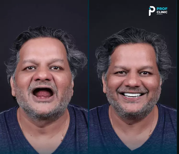 من جرب زراعة الأسنان الفورية؟ 